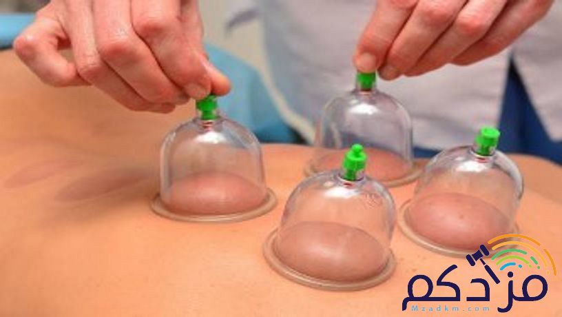 الحجامة العلاجية والوقائية المنزلية